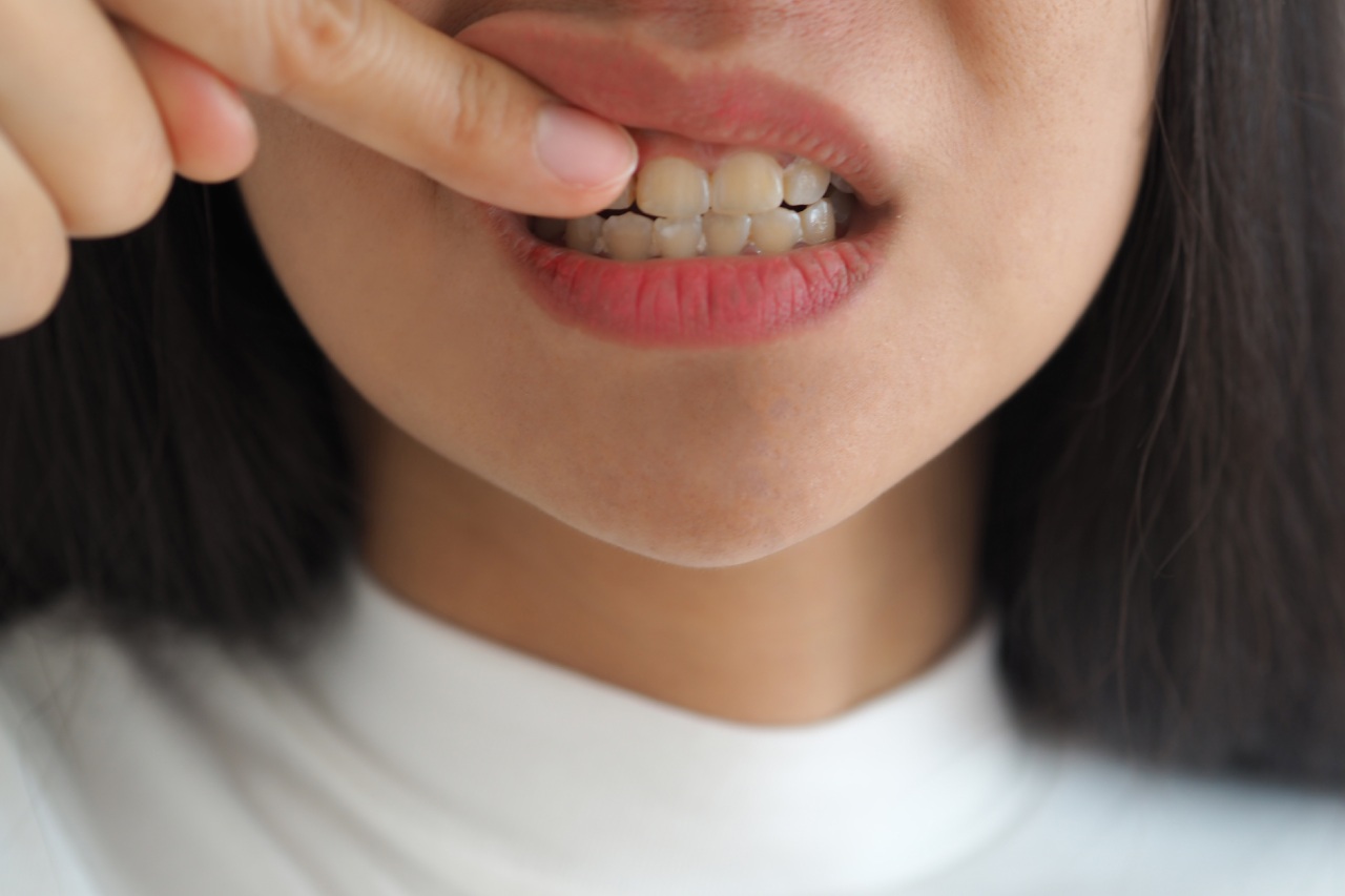 Mulher levanta o lábio para mostrar acúmulo de tártaro no dente e manchas amareladas na região da gengiva. Mulher levanta o lábio para mostrar acúmulo de tártaro no dente e manchas amareladas na região da gengiva.